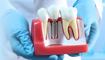 5 Things to Know Before Getting Teeth Implants
